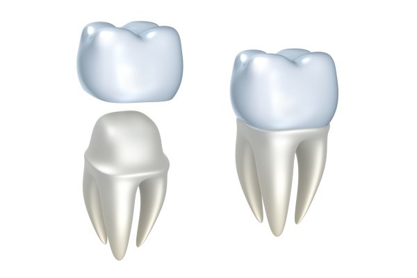 Dental Crowns and Dental Bridges Claremont, CA