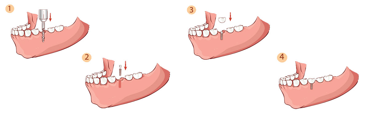 Claremont The Dental Implant Procedure
