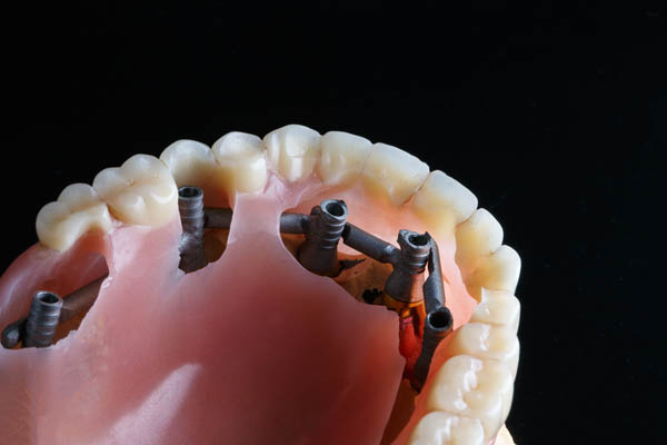How Long Does The Procedure For Implant Supported Dentures Take?