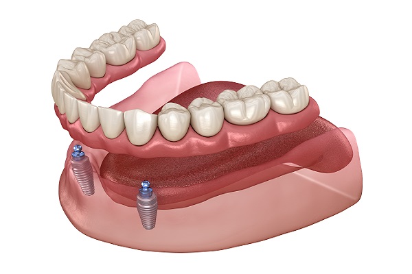Implant Supported Dentures Claremont, CA