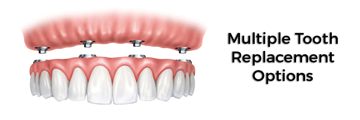 Claremont Multiple Teeth Replacement Options